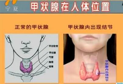 甲状腺结节.jpg