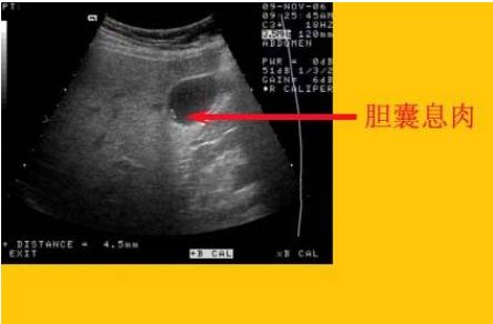 胆囊息肉.jpg