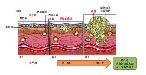 癌症(癌细胞)的扩散和转移有什么不同?